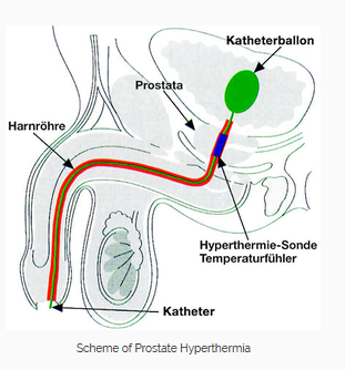 proteine ​​în urină cu prostatita cronică care sunt simptomele pentru prostatita la barbati